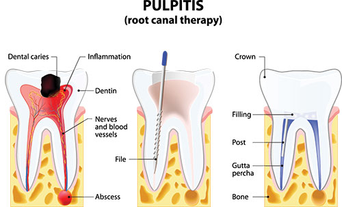 The image is a detailed medical illustration showing the structure of a human tooth, including its root canal therapy, with annotations explaining the different parts and their functions.